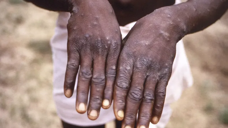 Le Zimbabwe signale ses deux premiers cas de mpox